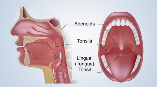 Benefits of Removing Tonsils